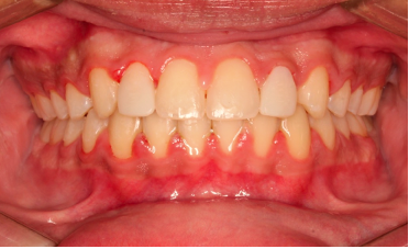 Up-close photo of a mouth after veneers and dental bonding