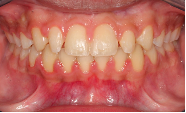 Up-close photo of a mouth before veneers and dental bonding