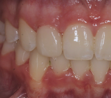 Up-close photo of a mouth after veneers and dental bonding