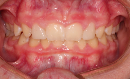 Up-close photo of a mouth after veneers and dental bonding