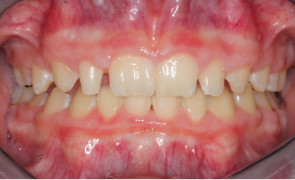 Up-close photo of a mouth before veneers and dental bonding
