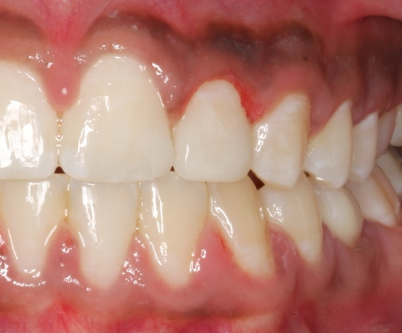 Up-close photo of a mouth after veneers and dental bonding