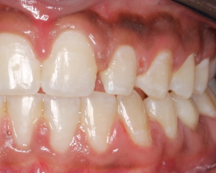Up-close photo of a mouth before veneers and dental bonding