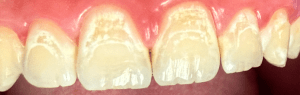 Icon Resin Infiltration 1 Before