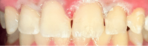 Icon Resin Infiltration 1 After