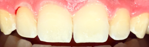 Icon Resin Infiltration 2 After
