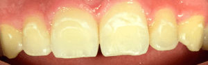 Icon Resin Infiltration 2 Before