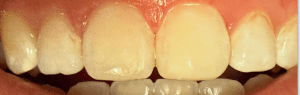 Icon Resin Infiltration 3 After