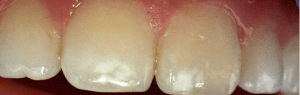 Icon Resin Infiltration 1 Before