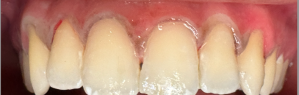 Icon Resin Infiltration 1 After