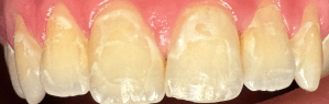 Icon Resin Infiltration 1 Before