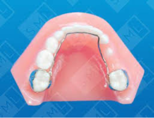Digital image of a retainer