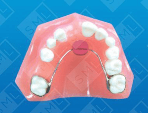 Digital image of a retainer