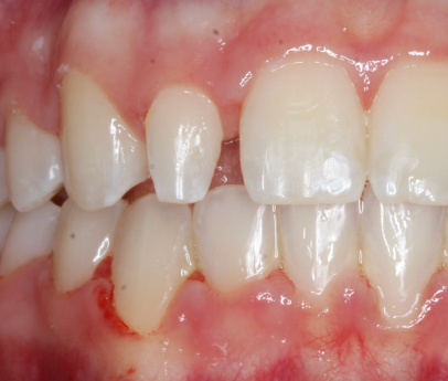 Up-close photo of a mouth before veneers and dental bonding